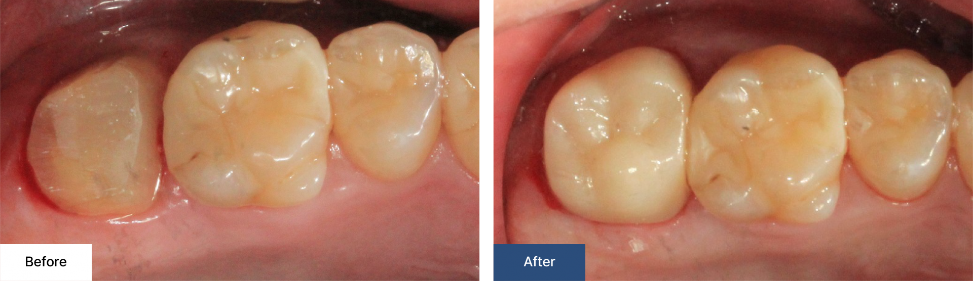 Cavity treatment 4