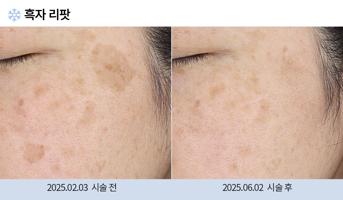 기미/주근깨/흑자 이미지