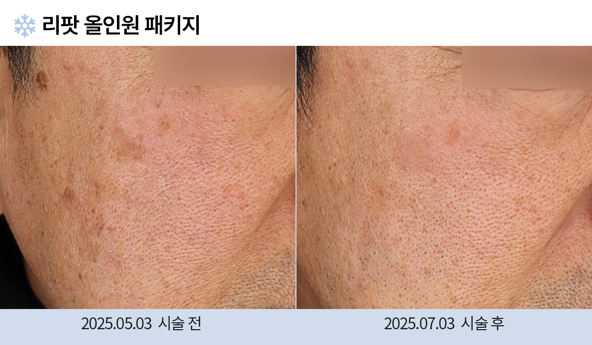 기미/주근깨/흑자 이미지