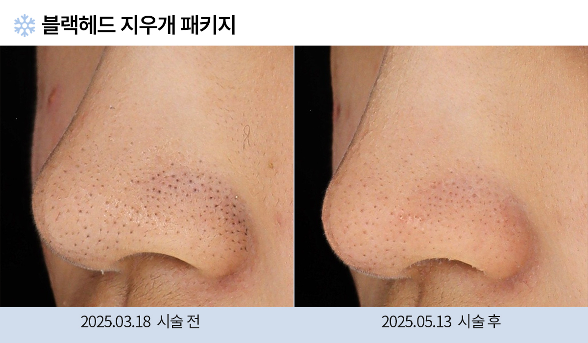 기미/주근깨/흑자 이미지