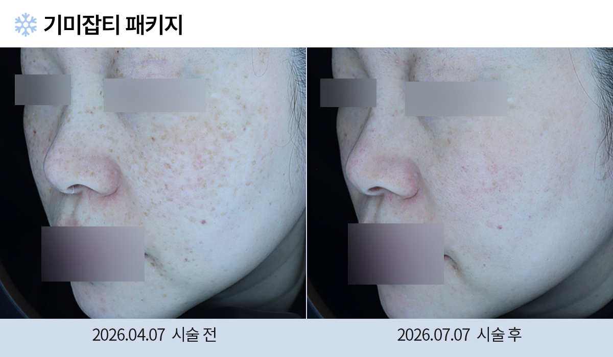 기미/주근깨/흑자 이미지