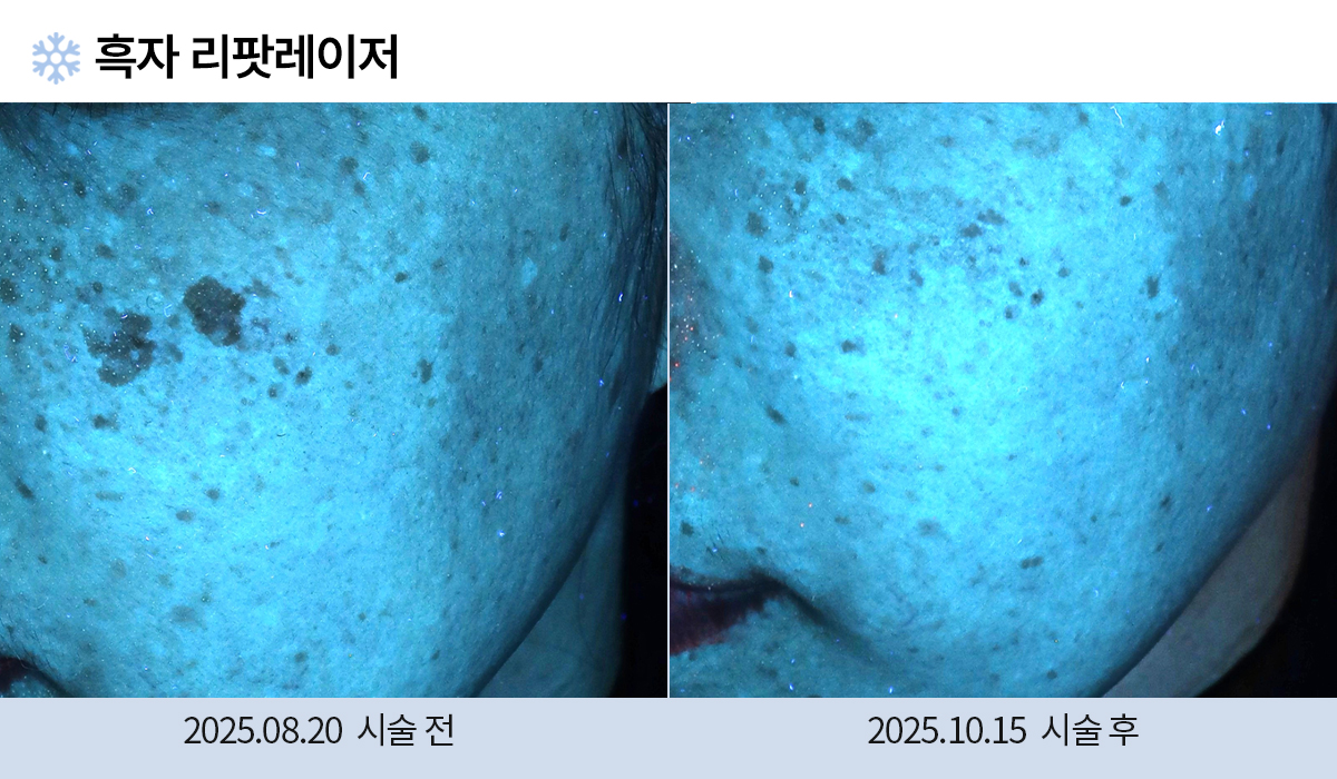 기미/주근깨/흑자 이미지