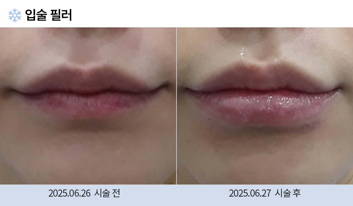 필러/보톡스 시술 전후 작업 이미지