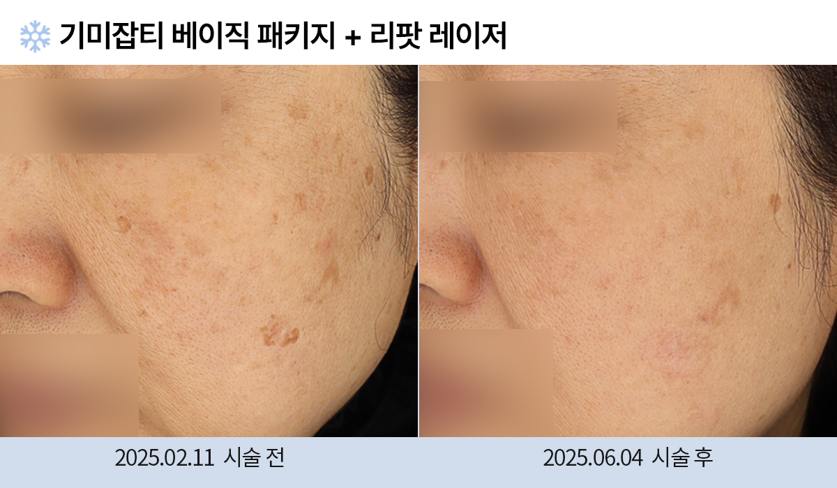 기미/주근깨/흑자 이미지