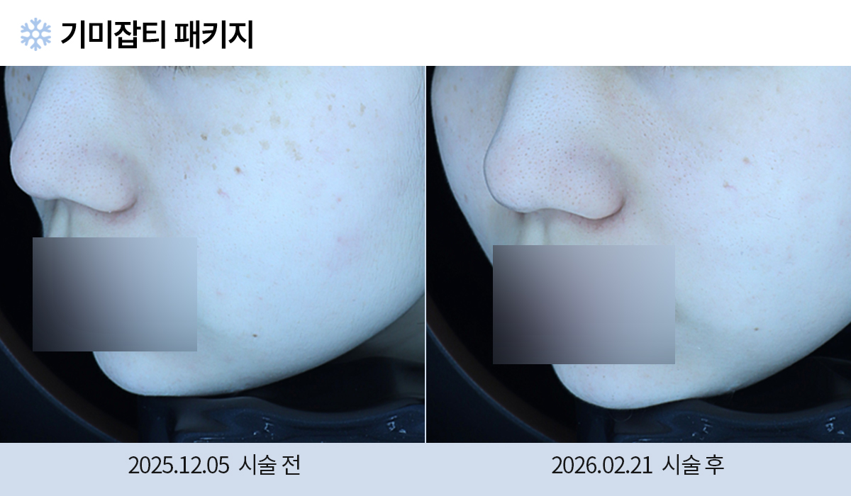 기미/주근깨/흑자 이미지
