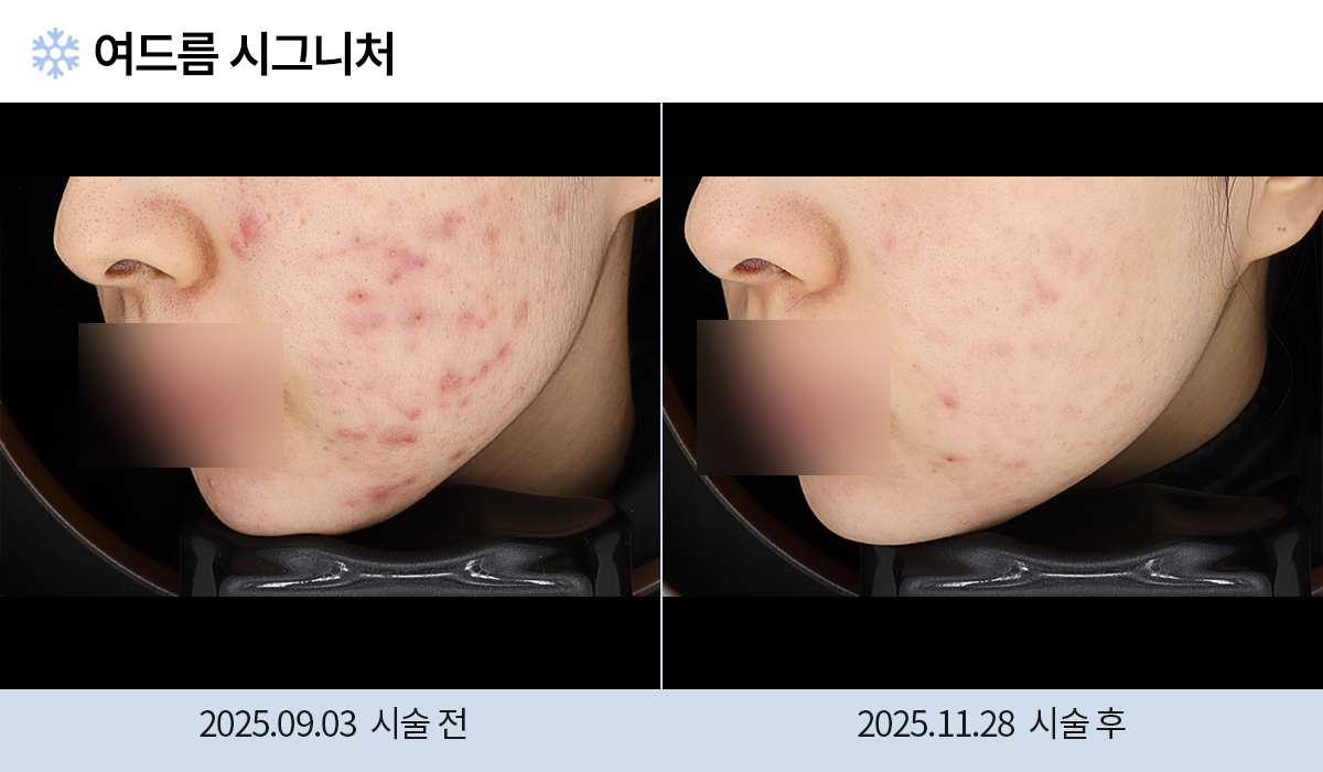 여드름/붉은자국/홍조 이미지