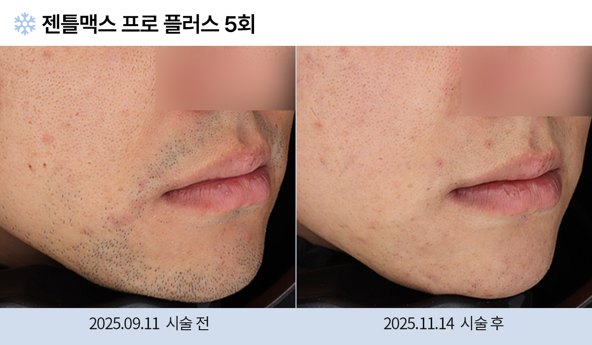 레이저 제모 전후 작업 이미지