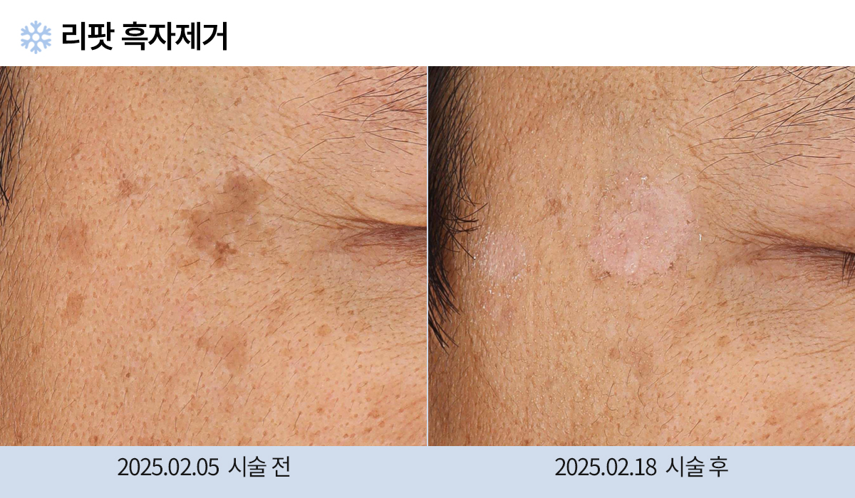 기미/주근깨/흑자 이미지