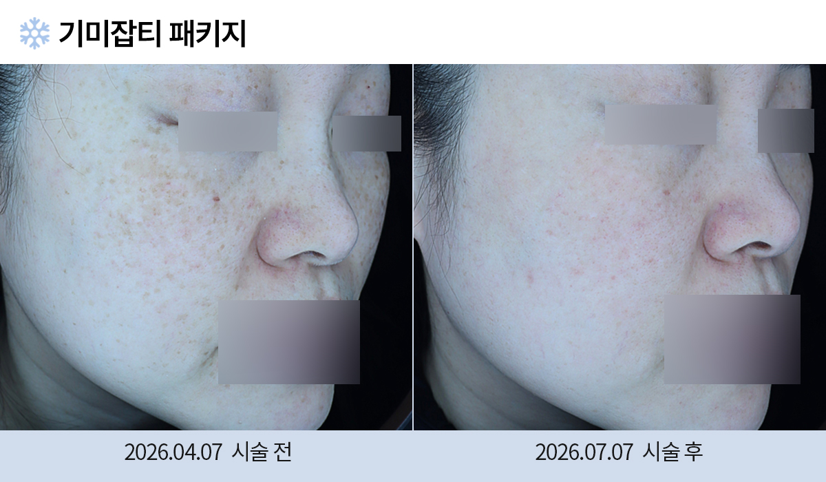 기미/주근깨/흑자 이미지
