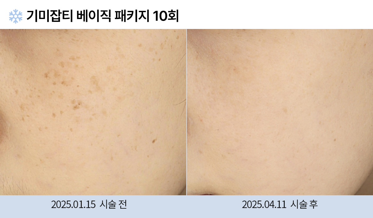 기미/주근깨/흑자 이미지