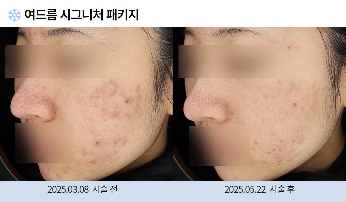 여드름/붉은자국/홍조 이미지