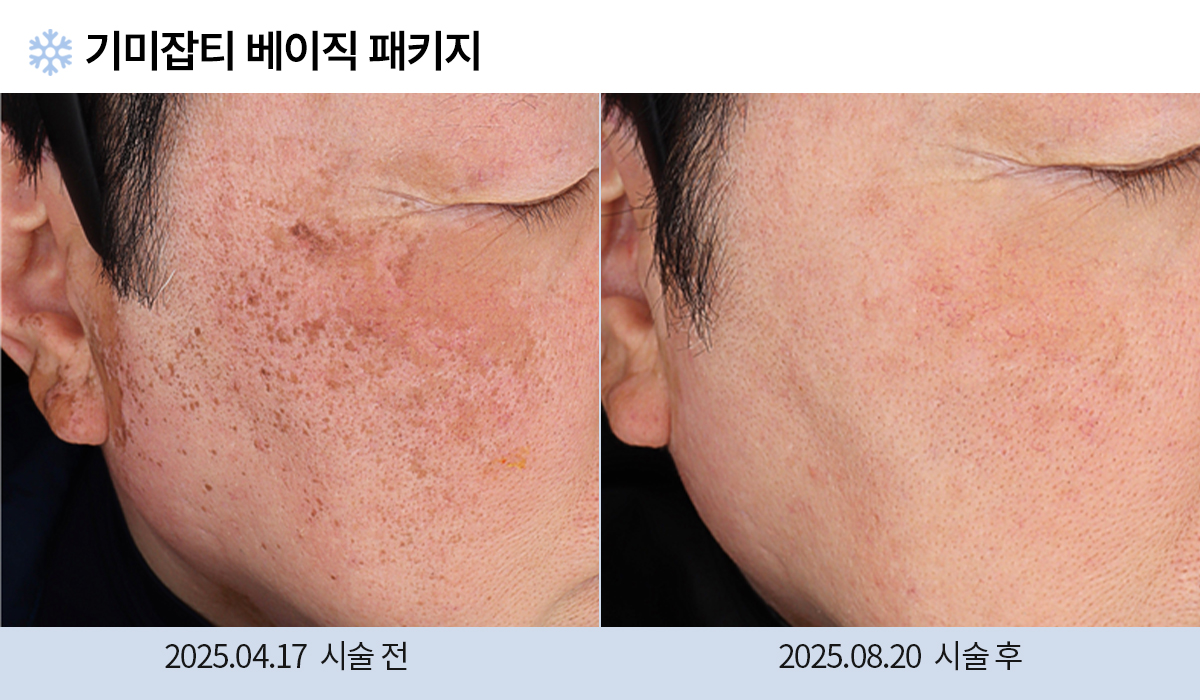 기미/주근깨/흑자 이미지