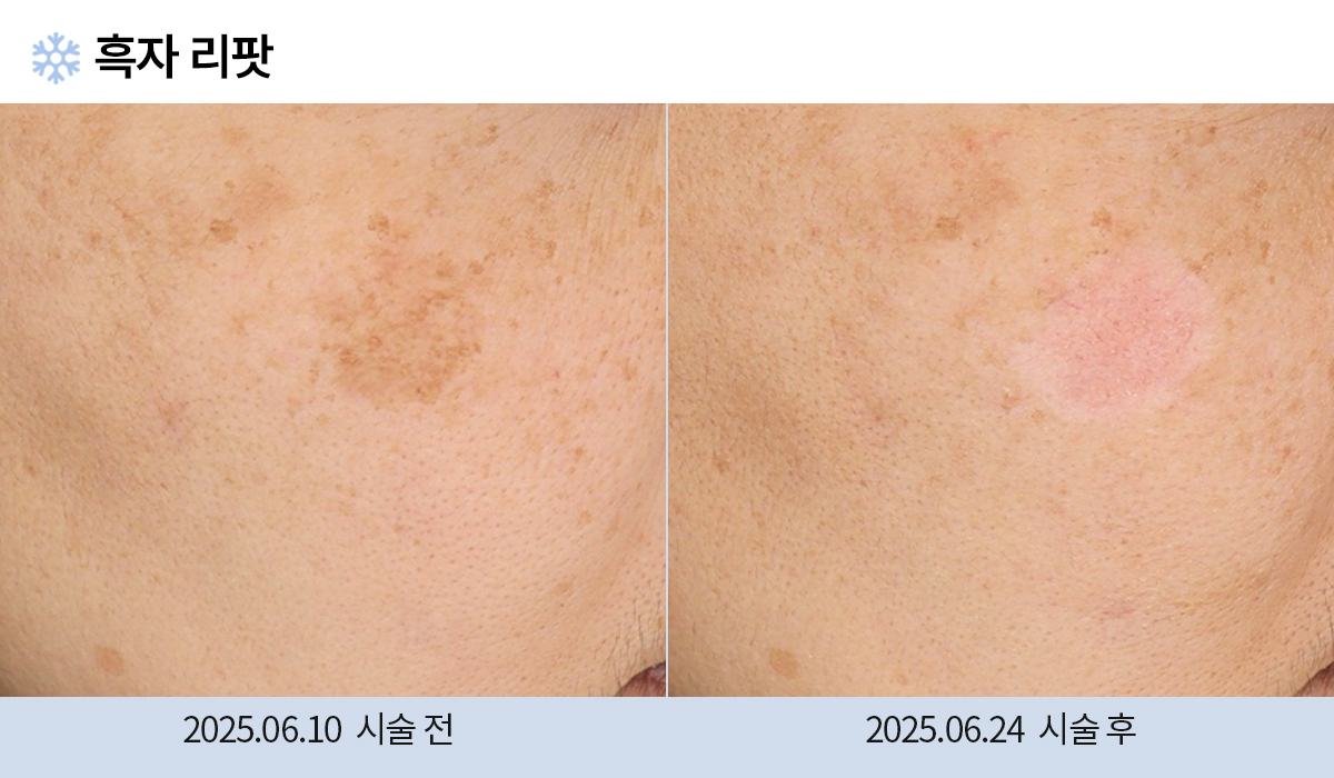 기미/주근깨/흑자 이미지