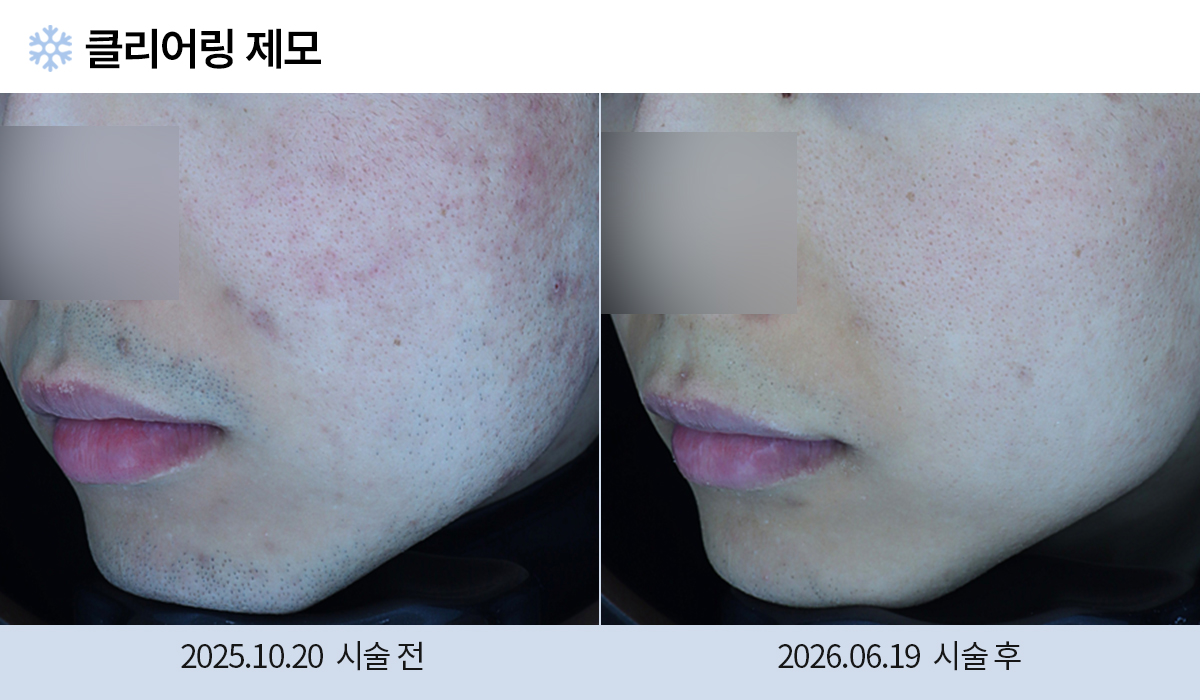 레이저 제모 전후 작업 이미지