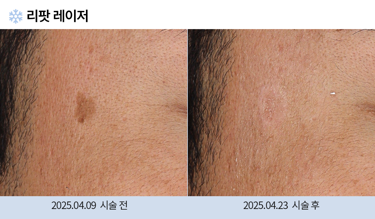 기미/주근깨/흑자 이미지