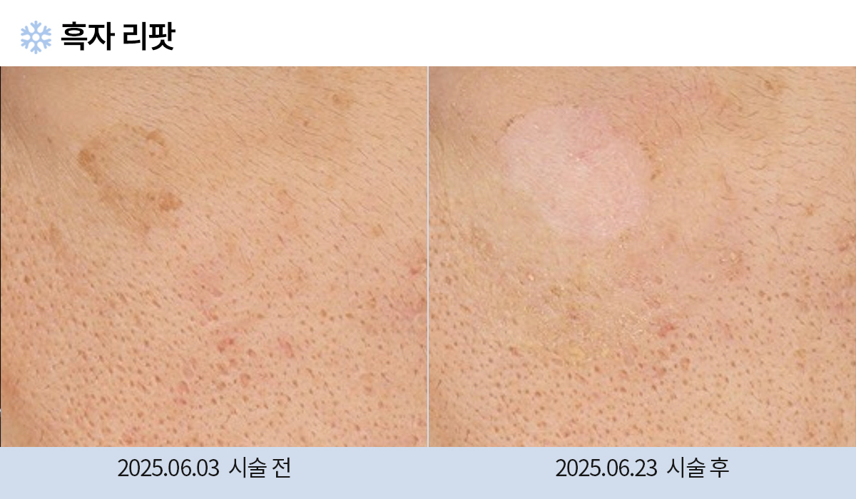 기미/주근깨/흑자 이미지