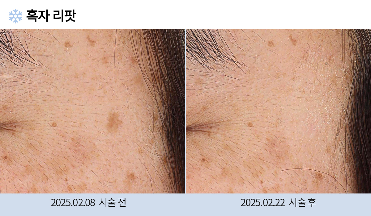 기미/주근깨/흑자 이미지