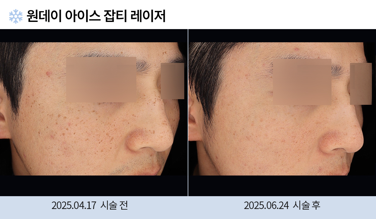 기미/주근깨/흑자 이미지