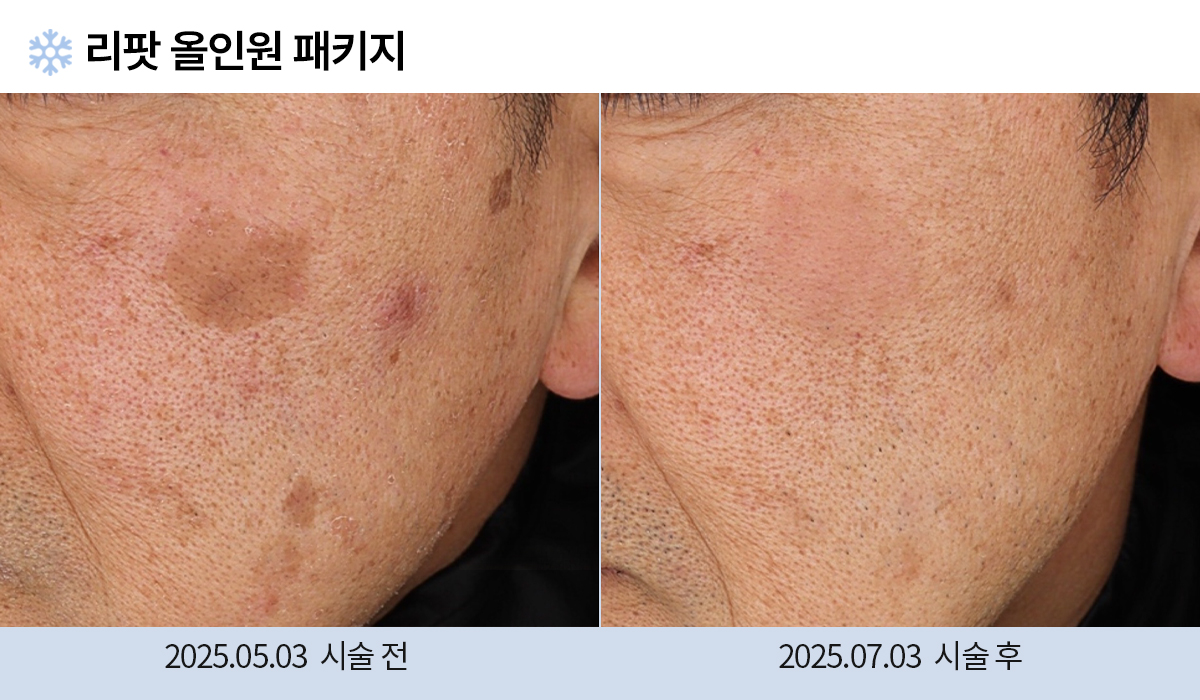 기미/주근깨/흑자 이미지