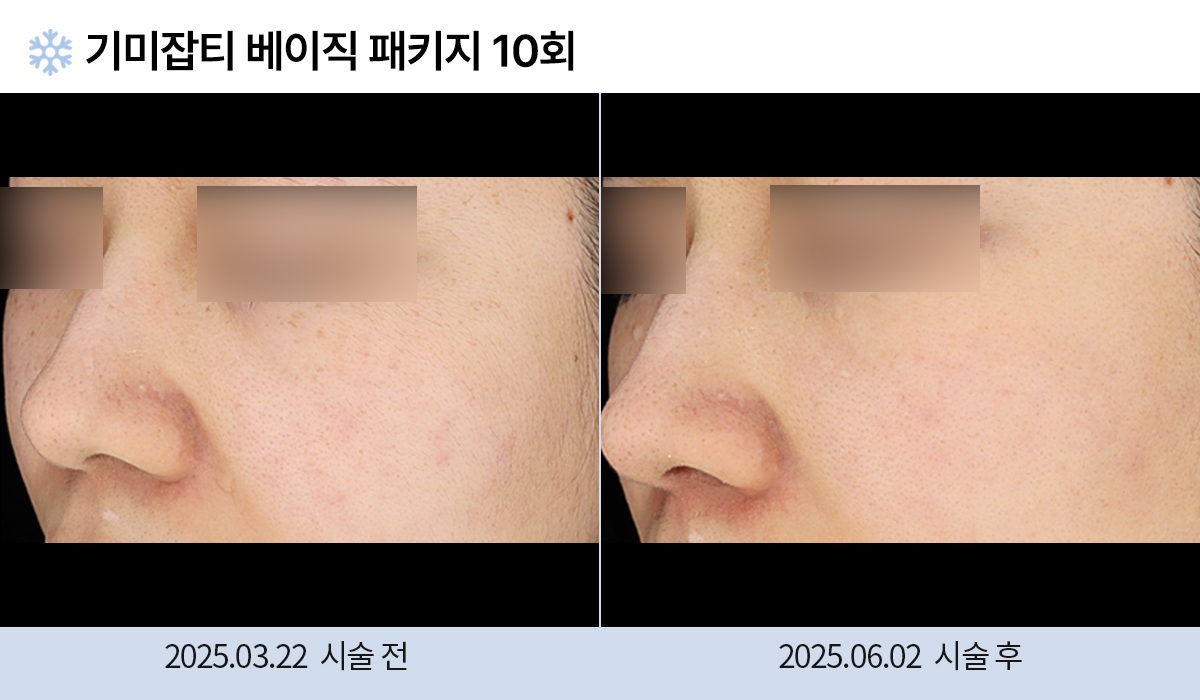 기미/주근깨/흑자 이미지