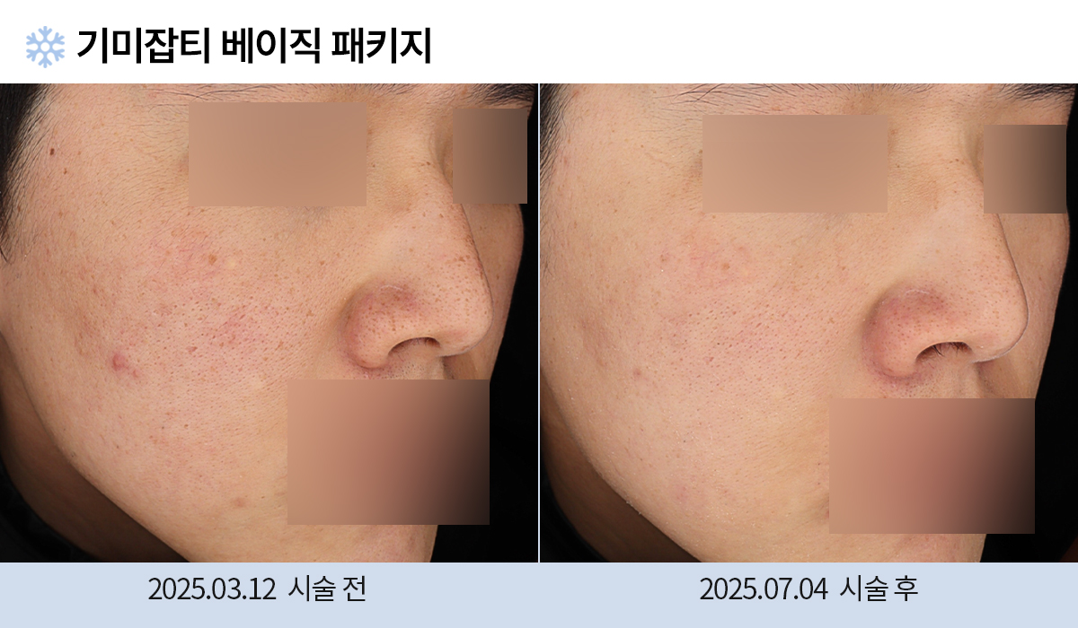 기미/주근깨/흑자 이미지