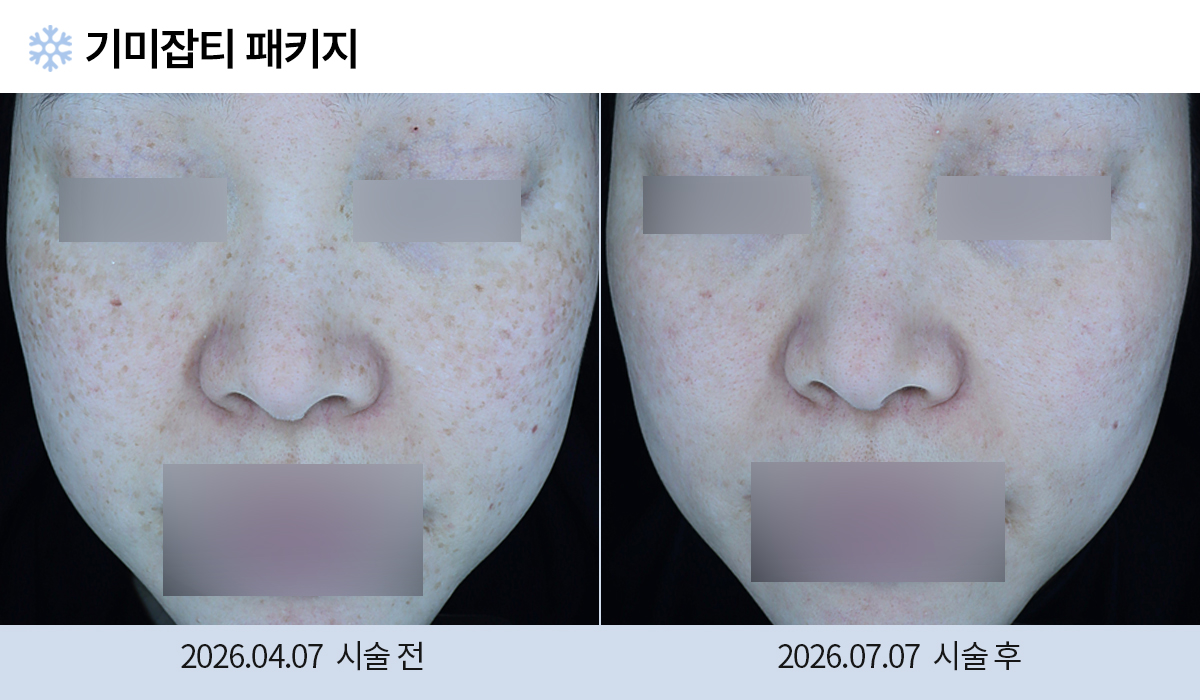 기미/주근깨/흑자 이미지