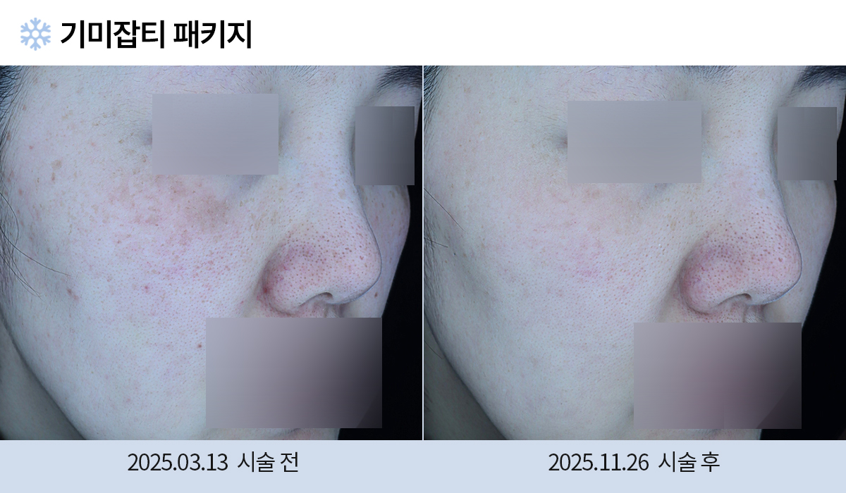 기미/주근깨/흑자 이미지