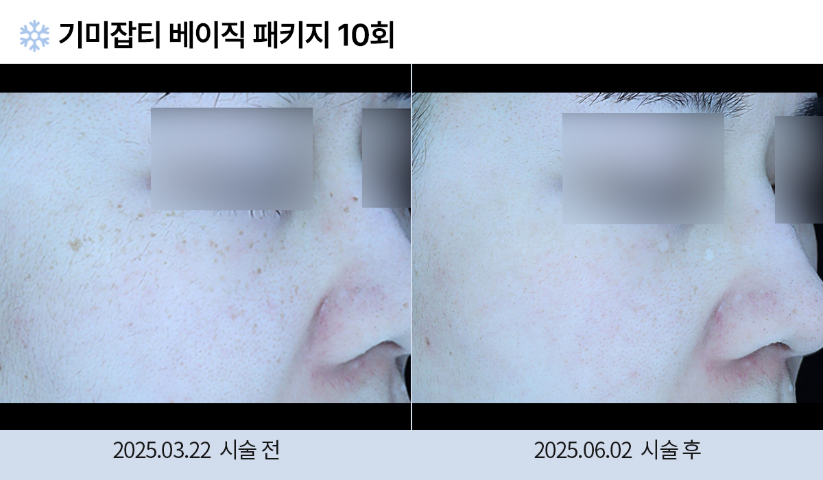 기미/주근깨/흑자 이미지