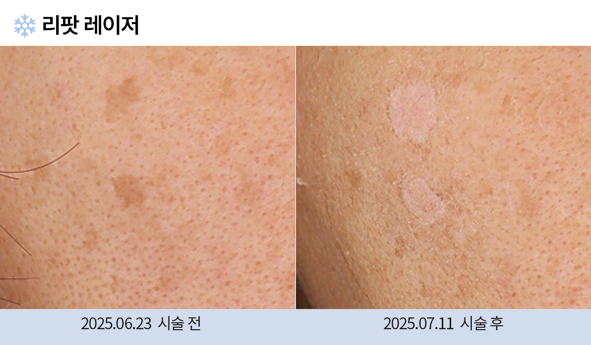 기미/주근깨/흑자 이미지