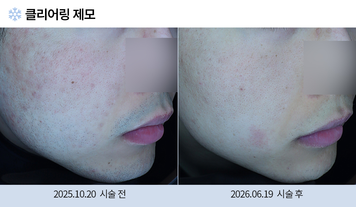 레이저 제모 전후 작업 이미지
