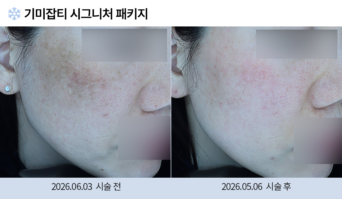 기미/주근깨/흑자 이미지