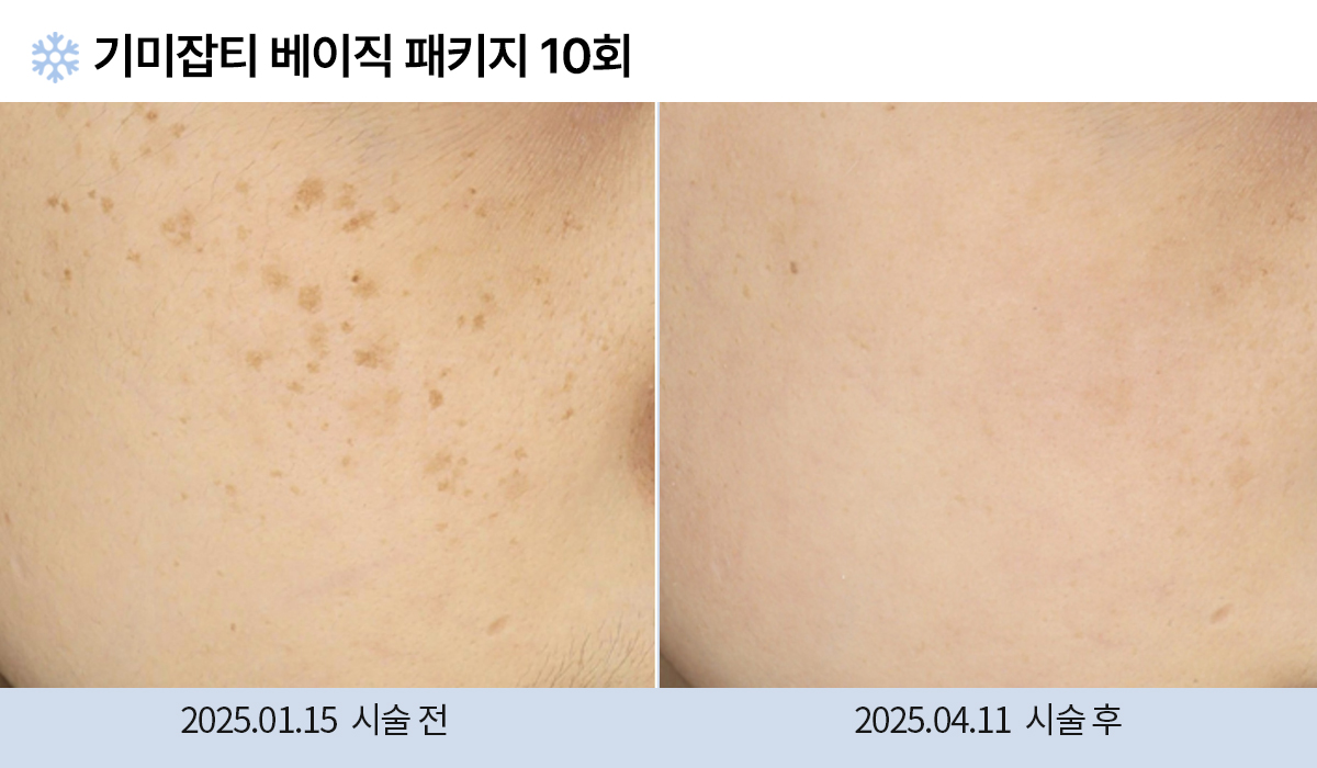 기미/주근깨/흑자 이미지