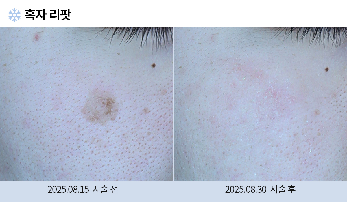 기미/주근깨/흑자 이미지