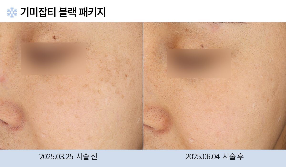 기미/주근깨/흑자 이미지