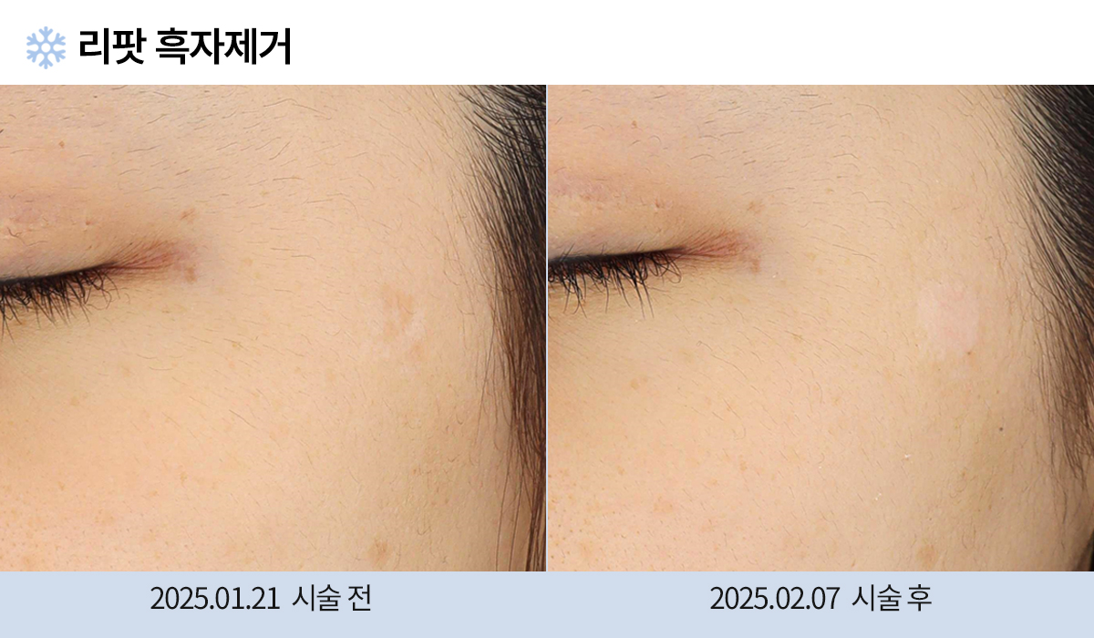 기미/주근깨/흑자 이미지