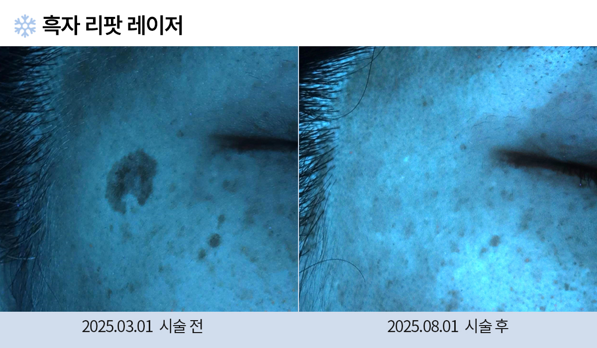 기미/주근깨/흑자 이미지