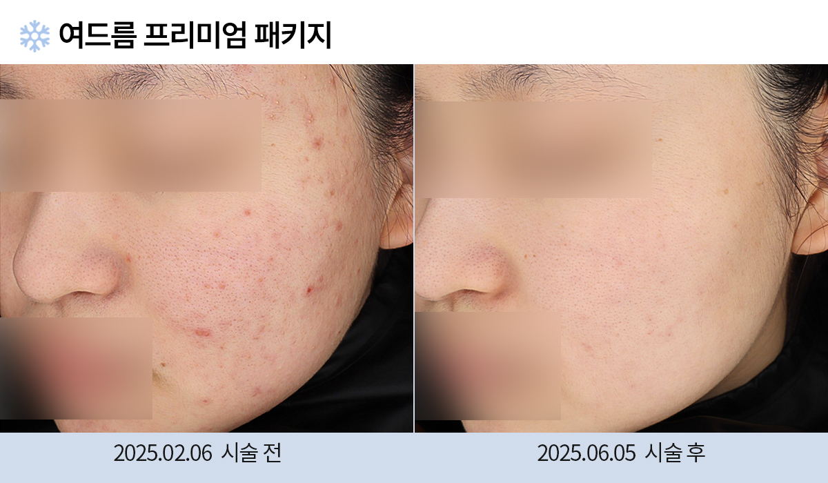 여드름/붉은자국/홍조 이미지