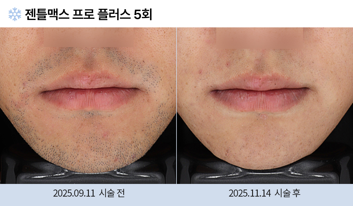 레이저 제모 전후 작업 이미지