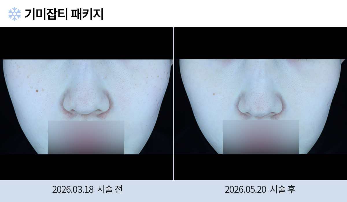 기미/주근깨/흑자 이미지