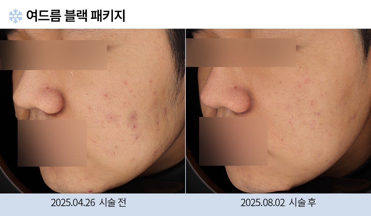 여드름/붉은자국/홍조 이미지