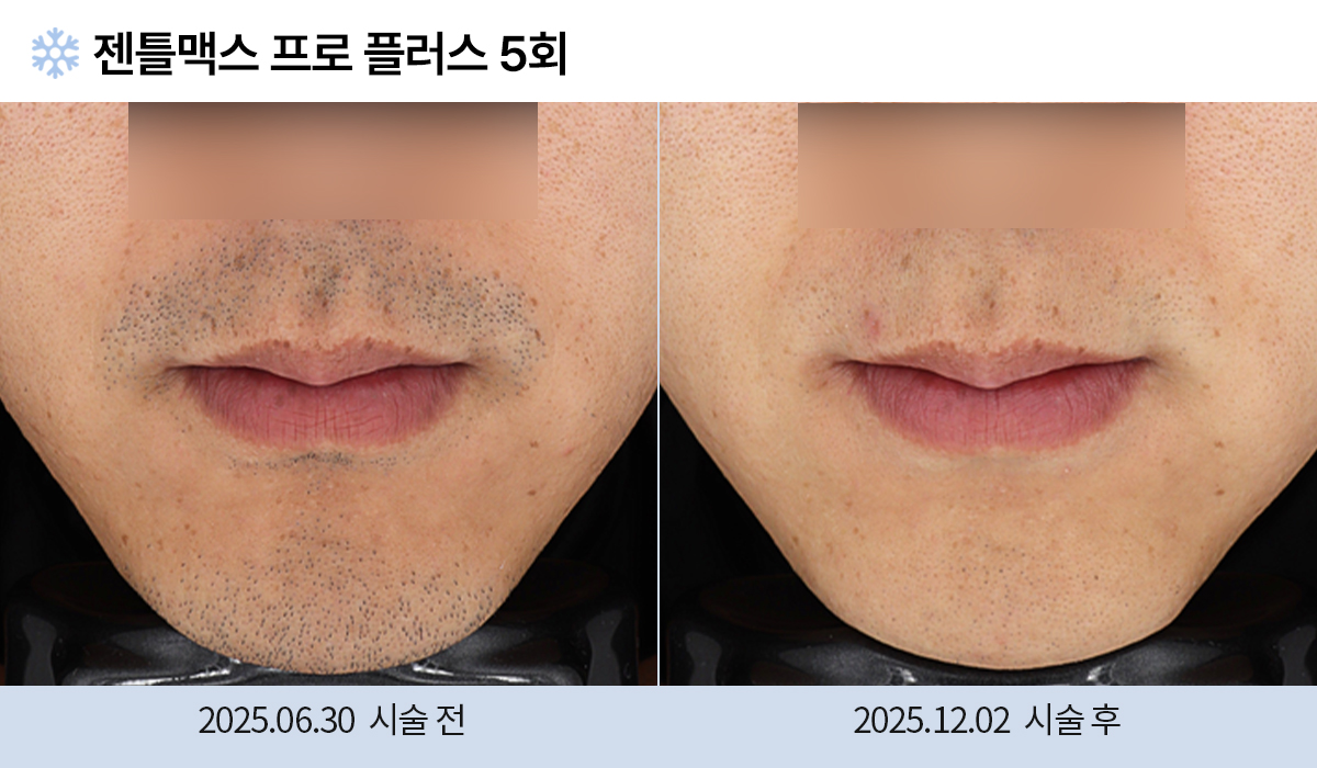 레이저 제모 전후 작업 이미지