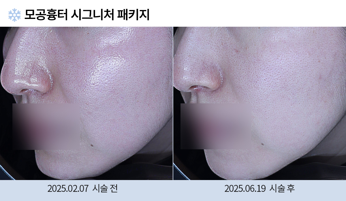 모공/주름/흉터 전후 작업 이미지