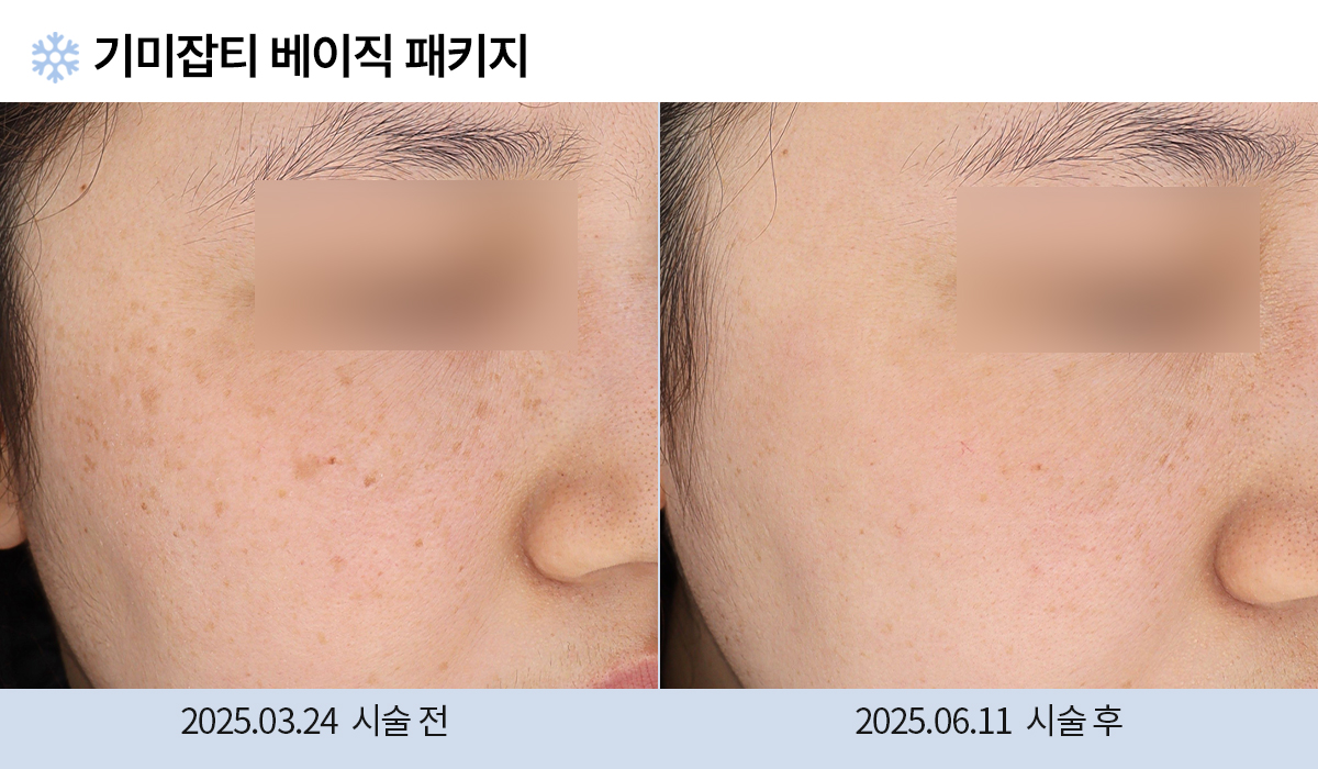 기미/주근깨/흑자 이미지