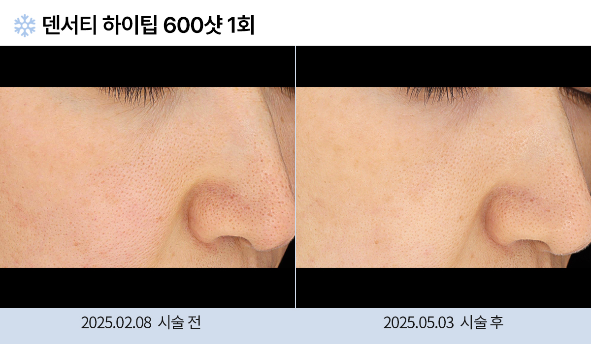 리프팅/피부탄력개선 전후 작업 이미지