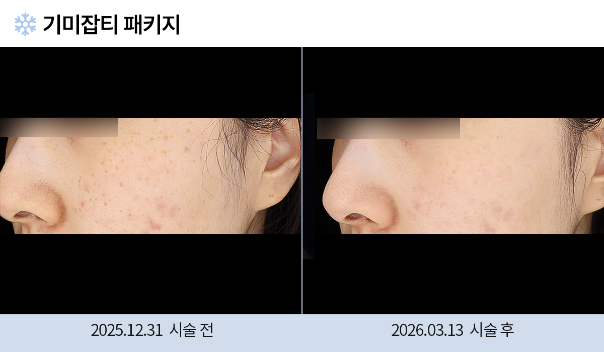 기미/주근깨/흑자 이미지