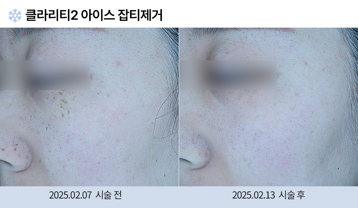 기미/주근깨/흑자 이미지