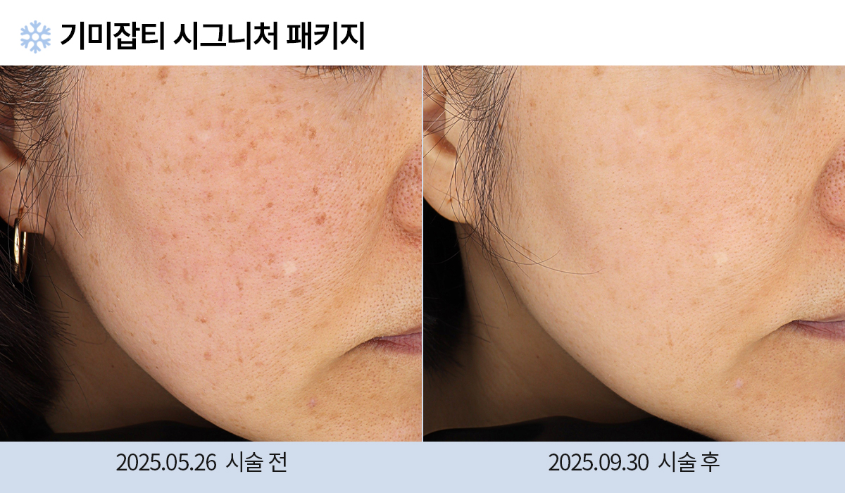 기미/주근깨/흑자 이미지