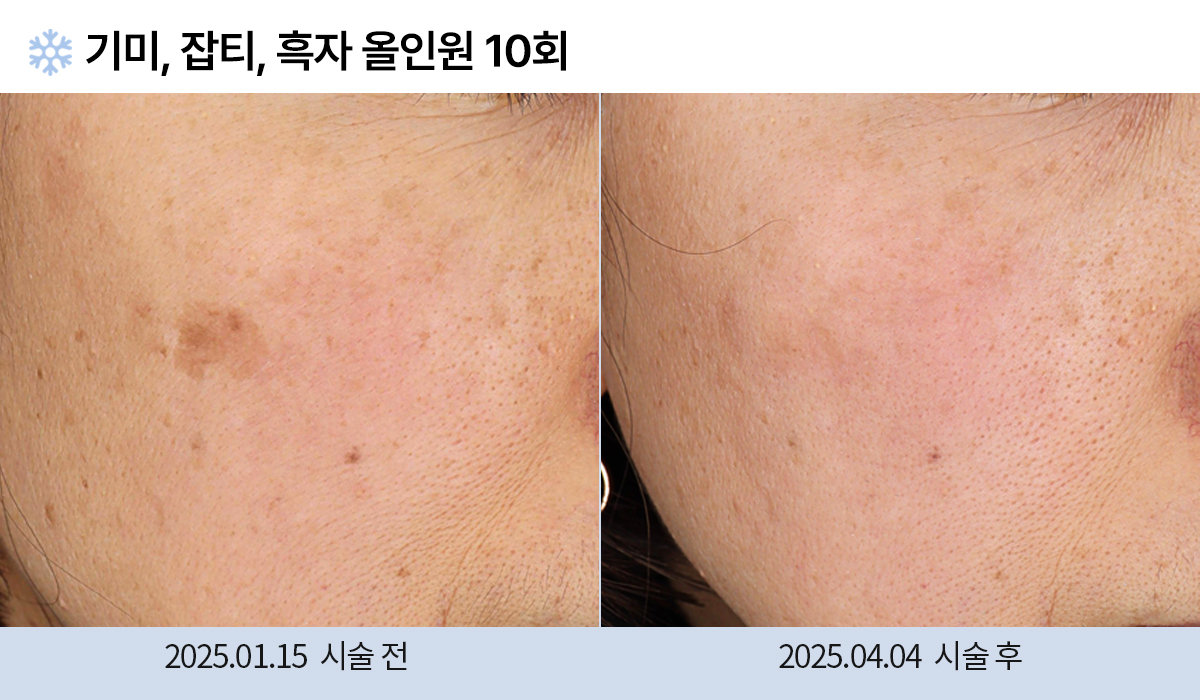 기미/주근깨/흑자 이미지