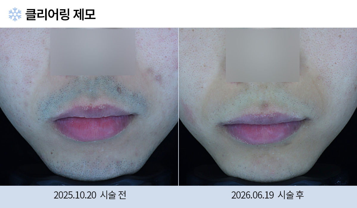 레이저 제모 전후 작업 이미지