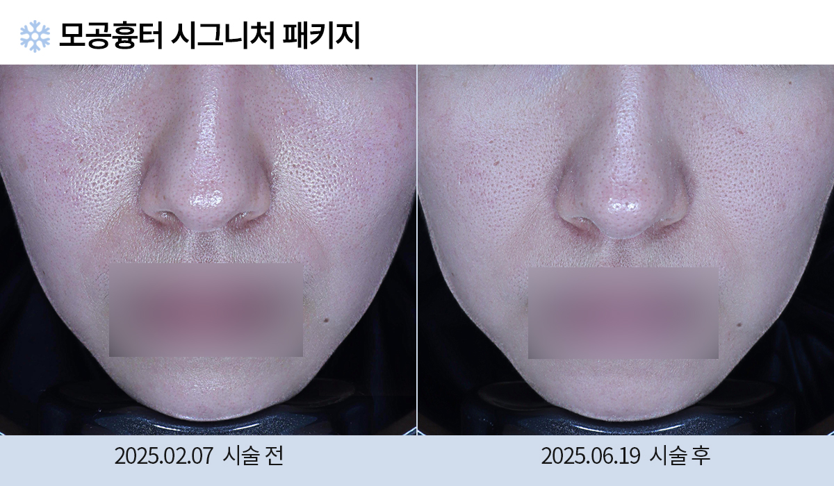 모공/주름/흉터 전후 작업 이미지